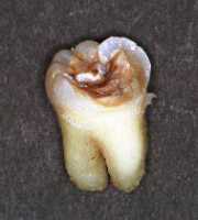 C3の歯