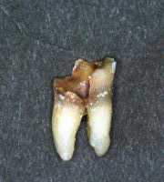 C4の歯